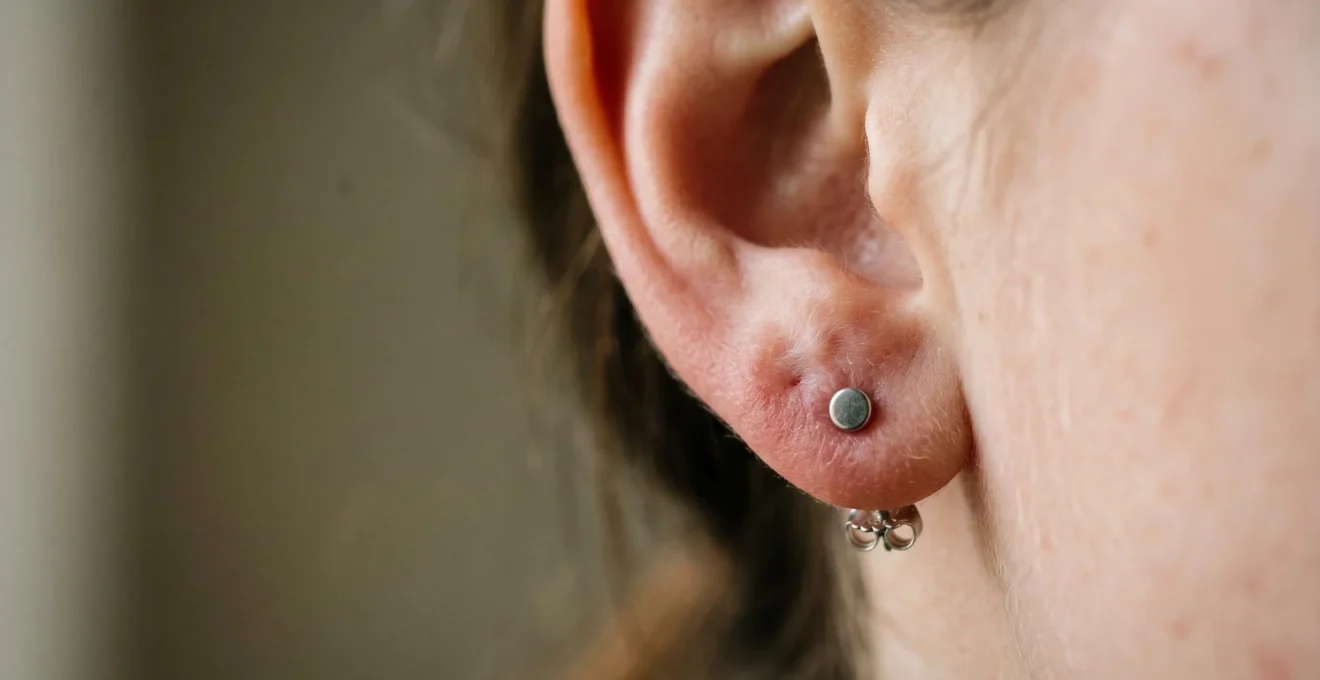 Gros plan sur le lobe d'une oreille avec une boucle d'oreille montrant une légère rougeur cutanée, illustrant les réactions allergiques aux métaux non conformes