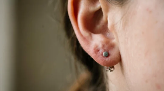 Gros plan sur le lobe d'une oreille avec une boucle d'oreille montrant une légère rougeur cutanée, illustrant les réactions allergiques aux métaux non conformes